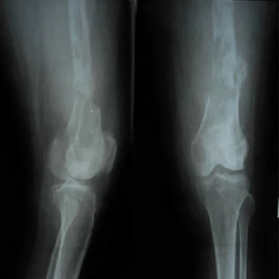 x-ray both thigh ap/lateral view test
